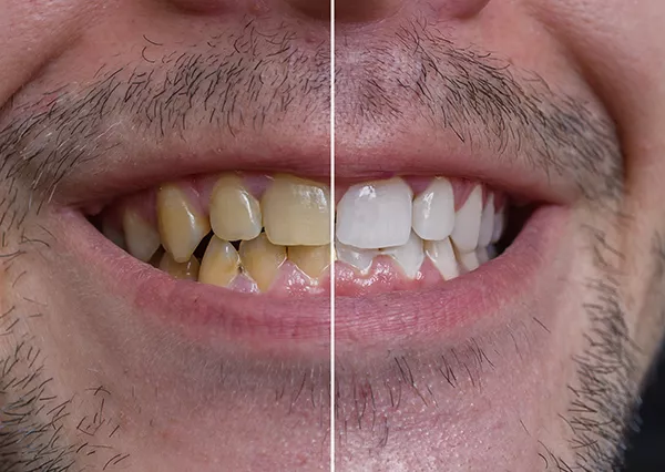 Bělení zubů Pure Whitening