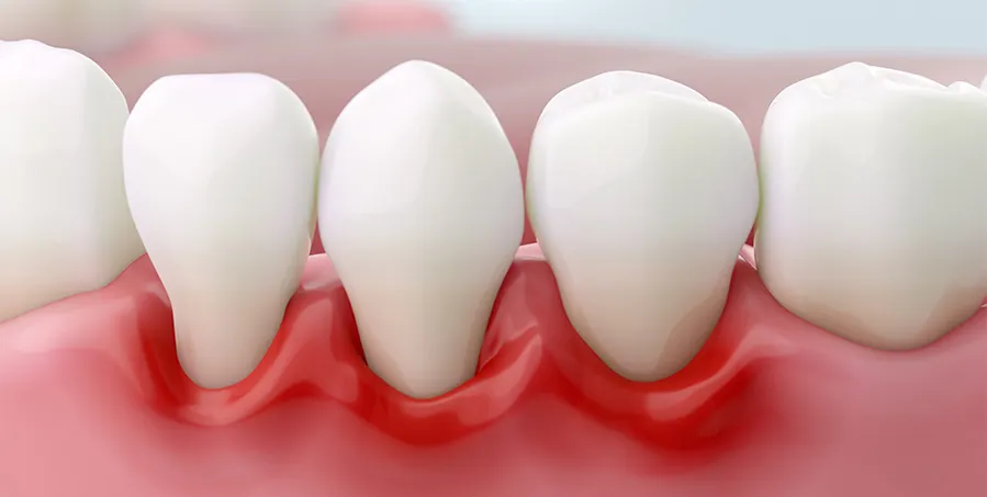 Odhalené zubní krčky