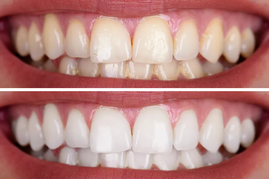 Před a po bělení zubů pure whitening